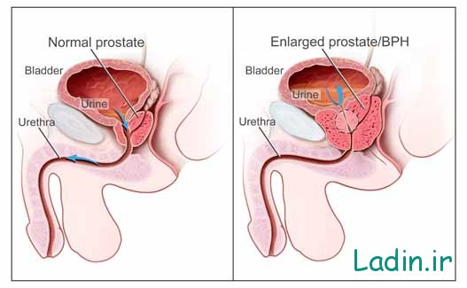 بزرگی پروستات Prostatic hyperp;asia