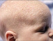 بیماری پوست نوزاد