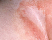سوختگی پوست نوزاد در اثر پوشک