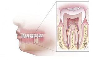 هزینه ی عصب کشی دندان