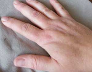 دلایل ورم کردن انگشتان دست ها نشانه چیست؟