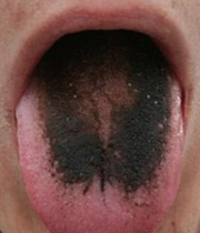 بیماری زبان تیره