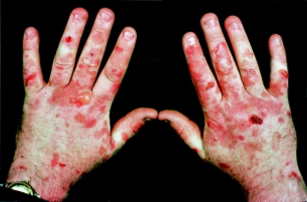 20-of-the-weirdest-and-rarest-diseases-known-to-mankind-14