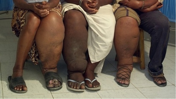 20-of-the-weirdest-and-rarest-diseases-known-to-mankind-6