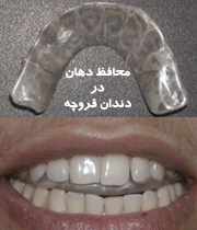 محافظ دهان در دندان قروچه