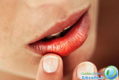 خشکی دهان شامل خشکی پوست هم میشود.