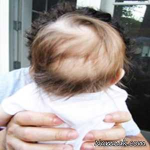 علت ریزش مو در کودکان ، انواع ریزش مو ، ریزش مو در کودکان