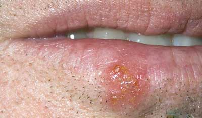 بیماریهای دهان و زبان
