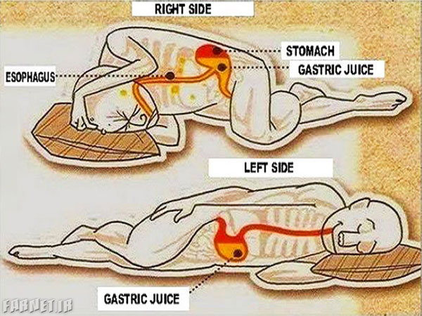 sleeping-on-the-left-side-vs-right-side-gastric-juice-stomach-esophagus